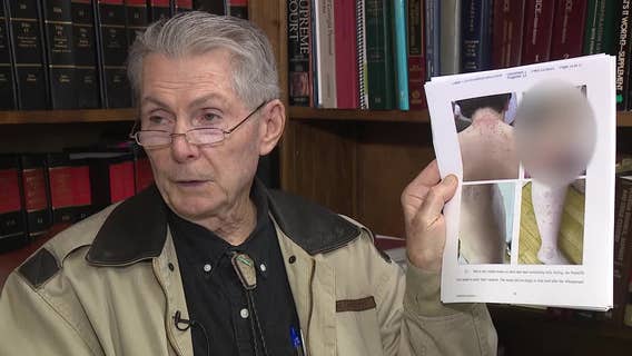 Lawsuit claims family bitten by bed bugs on international flight from Atlanta