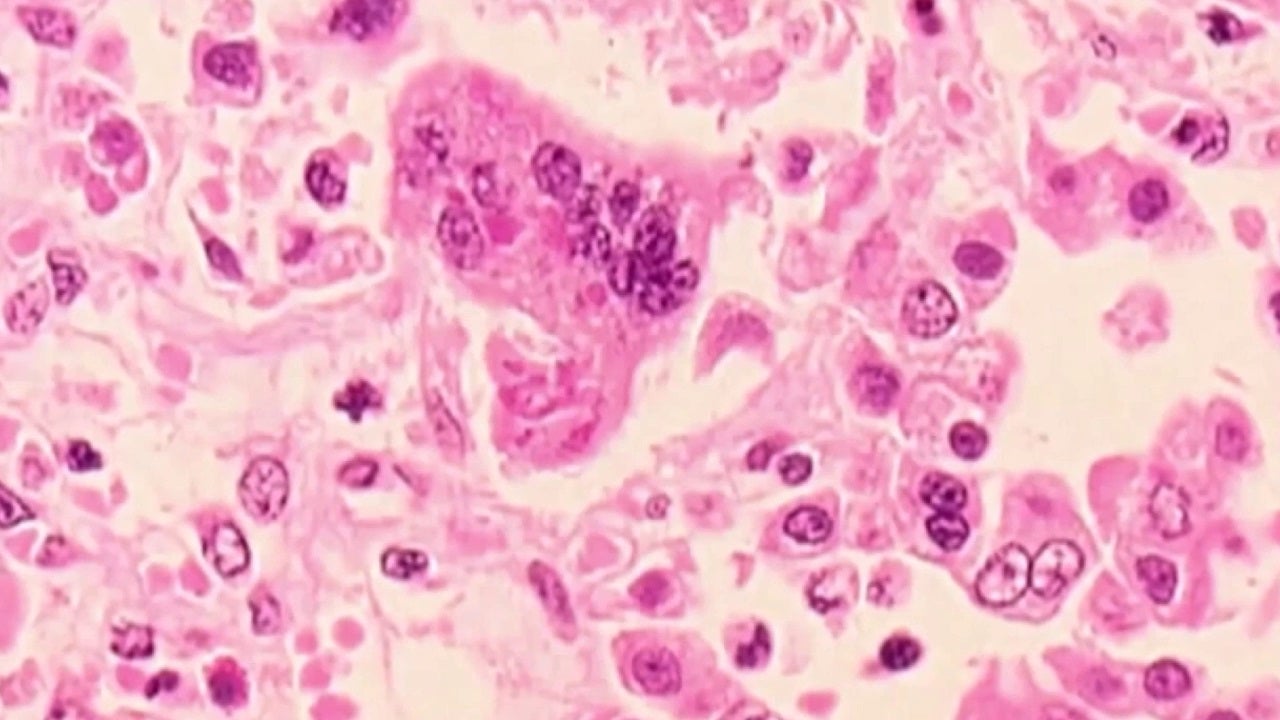 Doctors warn Georgia parents of measles outbreaks across the south