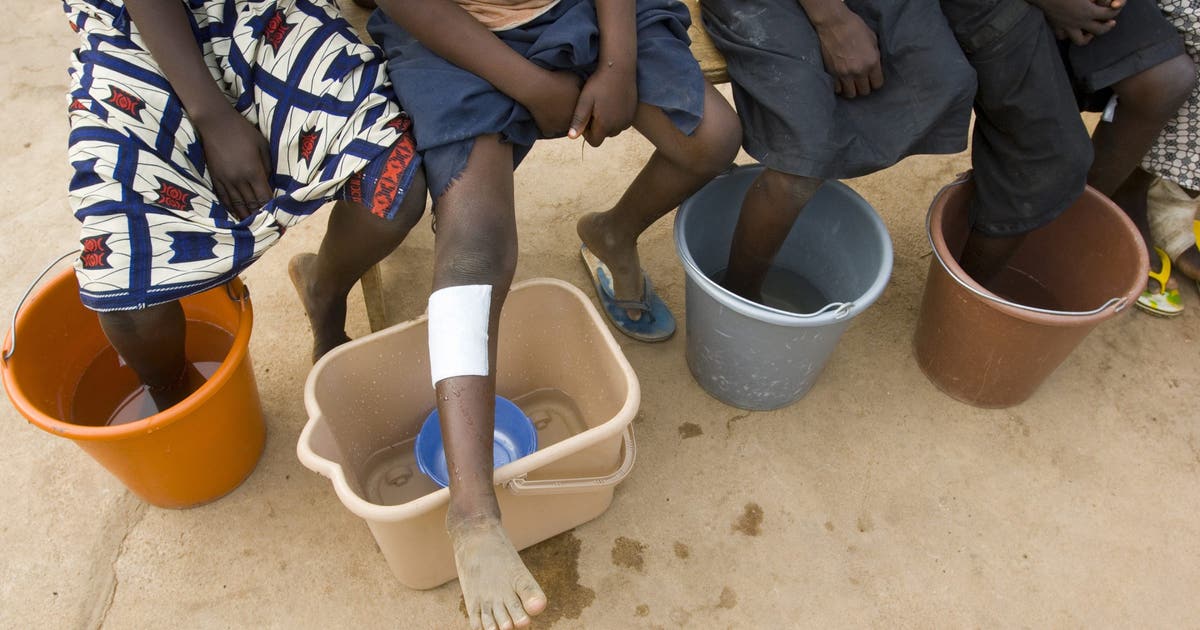 Ancient disease poised to become second ever to be eradicated: The Carter Center Ancient disease poised to become second ever to be eradicated: The Carter Center