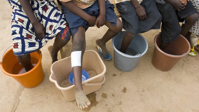 Ancient disease poised to become second ever to be eradicated: The Carter Center