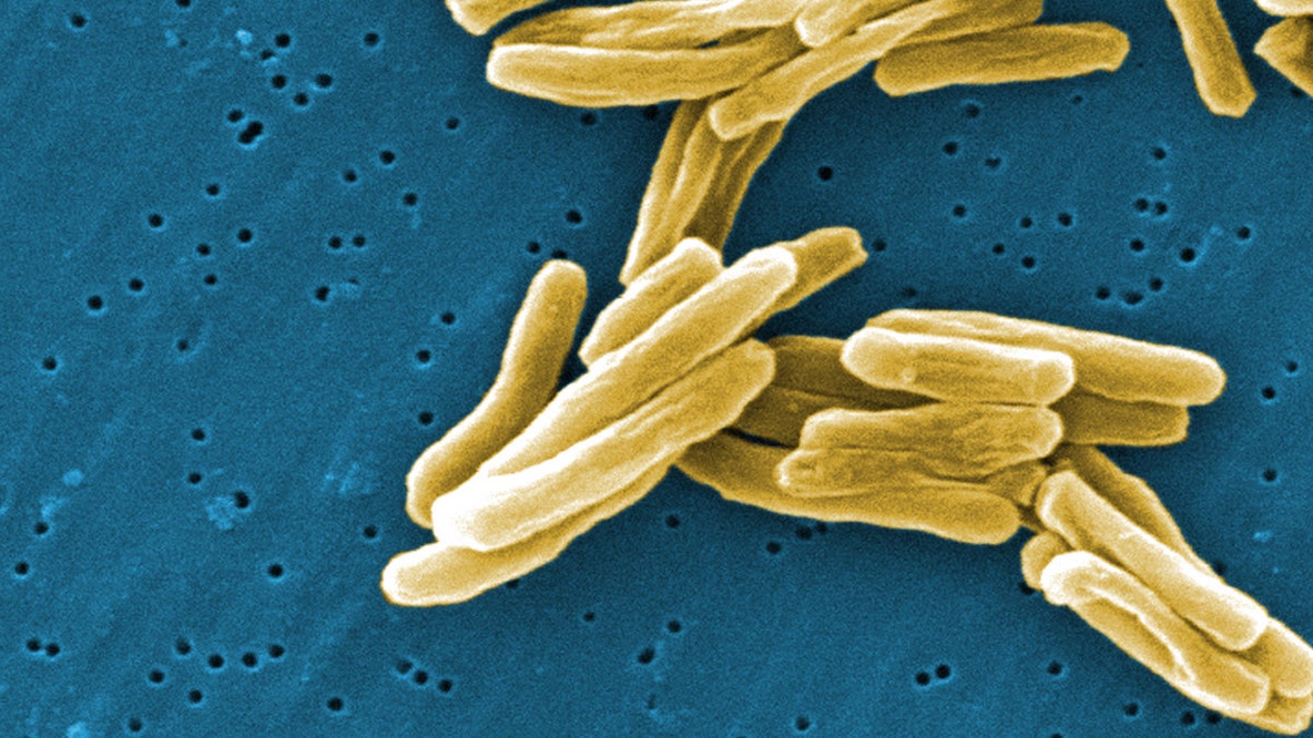Fulton County health officials warn of Johns Creek school tuberculosis case