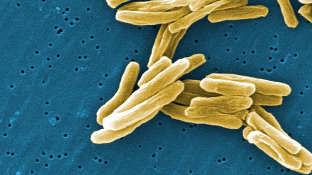 Tuberculosis case reported at Johns Creek school, families notified