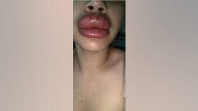 Valley women claim botched lip injections caused severe infection