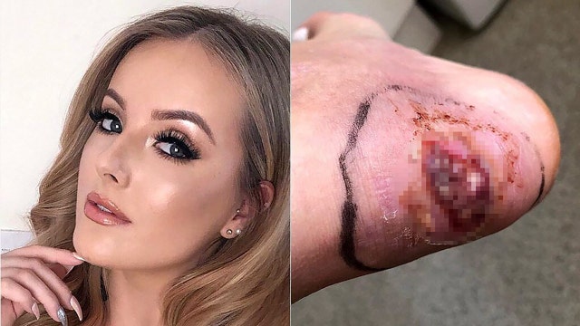 UK woman develops sepsis from blister on heel, claims she 'could have lost her leg'