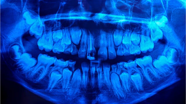 Boy has over 500 'teeth' removed after complaining of pain in jaw