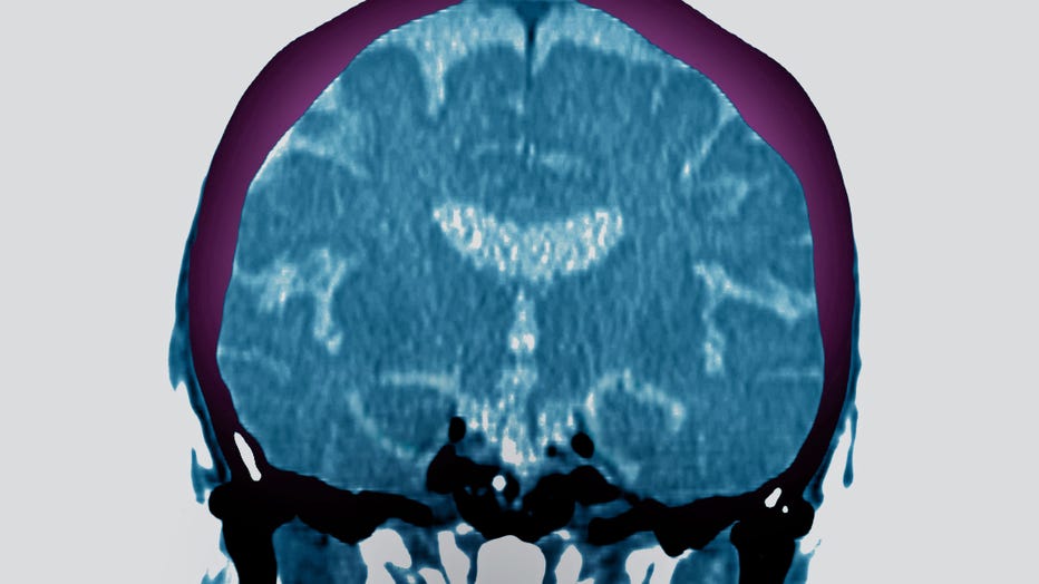 A radial CT-scan of a brain is shown in a file image. (Photo by: BSIP/Universal Images Group via Getty Images)