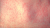 Confirmed case of measles reported at John Hanson Montessori in Prince George’s County