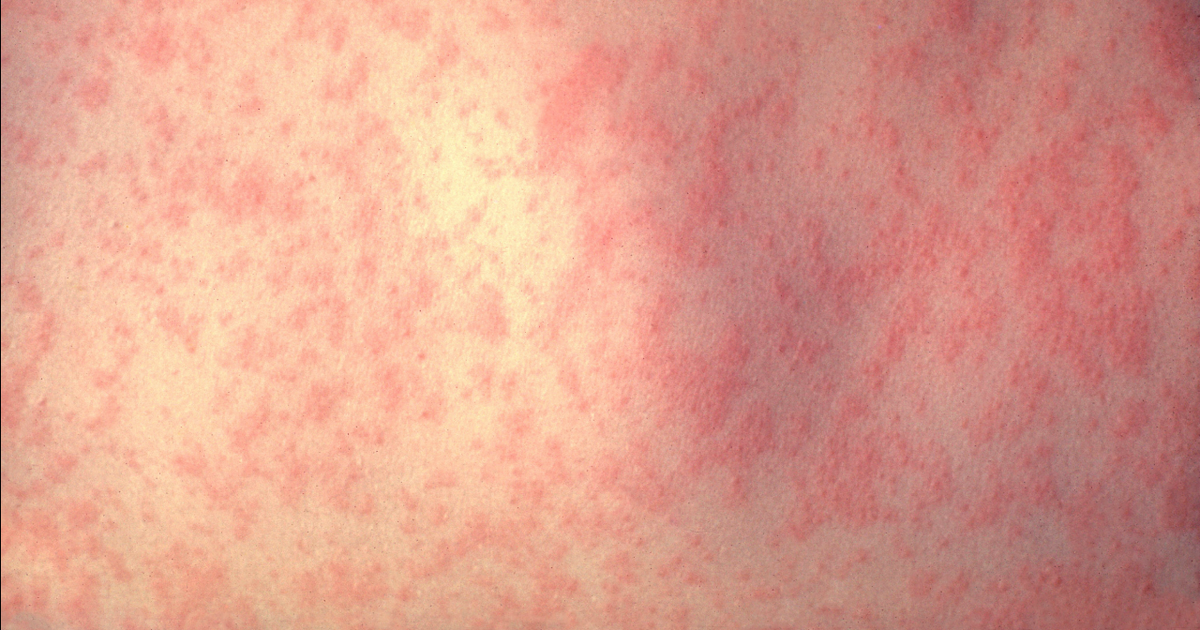 2 measles cases confirmed in northern Virginia; VDH lists possible exposure sites