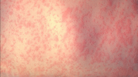 Potential measles exposure sites identified in DMV after confirmed case in preschool age child