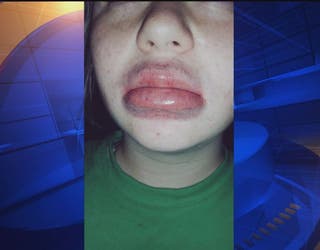 Kyliejennerchallenge 5 Things To Know About The Big Lip Trend 8 best remedies for swollen lip treatment | how to get rid of swollen lips fast a fat lip can humiliate and agonizing. 5 things to know about the big lip trend