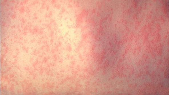 Measles case confirmed in Montgomery County; residents urged to monitor for symptoms