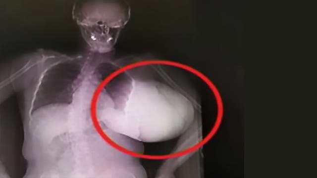 Woman has 'basketball-sized' breast tumor removed after letting it grow for 2 years, report says