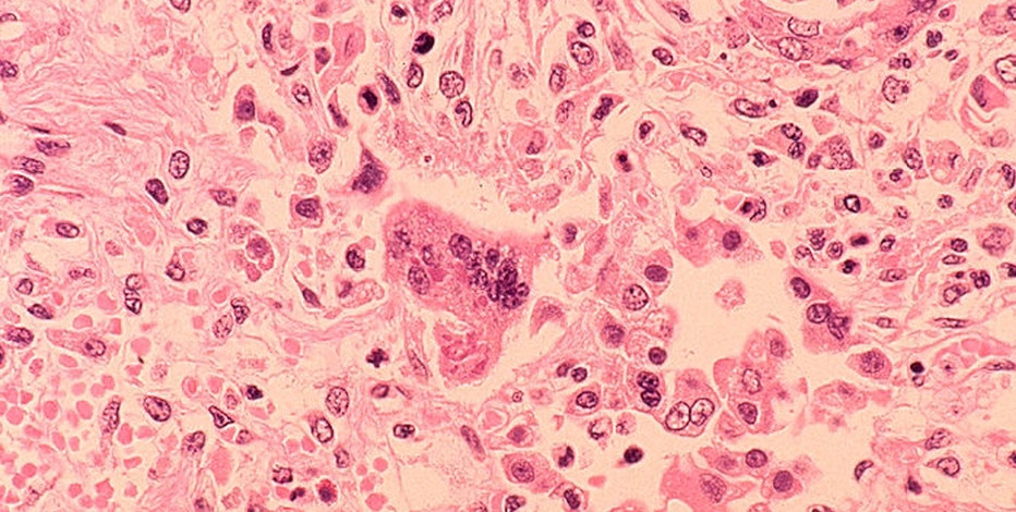Health officials across DMV issue exposure warnings after 2 confirmed cases of measles