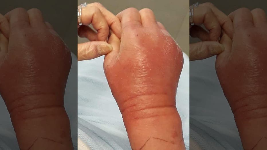 Woman Scratched By Spiteful Cat Develops Flesh Eating Bacteria