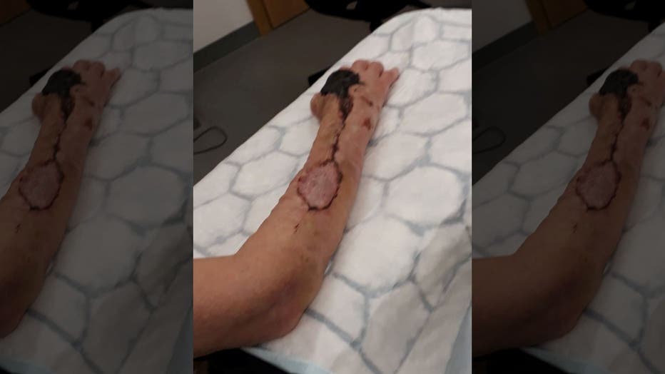 Woman Scratched By Spiteful Cat Develops Flesh Eating Bacteria Nearly Dies