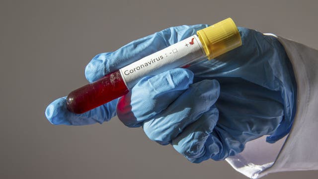 Coronavirus researchers discover potential virus impact on male fertility
