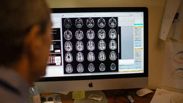 Company begins selling first blood test to help diagnose Alzheimer's