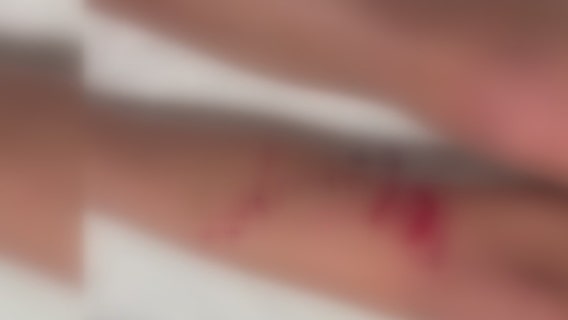 Girl injured in suspected shark attack in Ocean City, Maryland