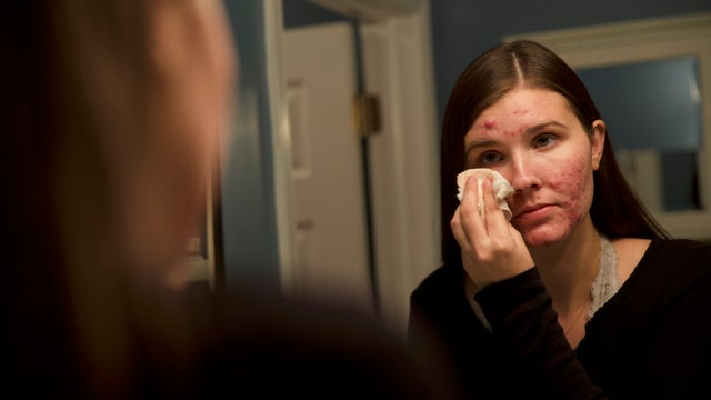 Dermatologists struggling to get acne drug Accutane due to safety, tech issues