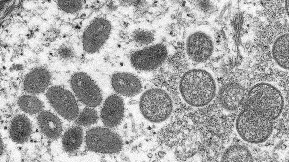 First presumed case of monkeypox in Virginia announced by health department