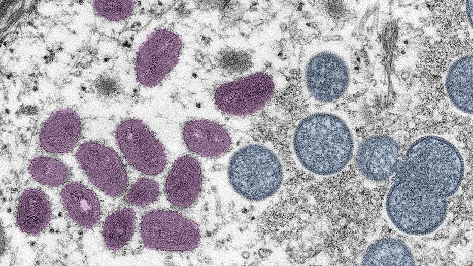 Digitally-colorized electron microscopic (EM) image depicting a monkeypox virion (virus particle), obtained from a clinical sample associated with a 2003 prairie dog outbreak, published June 6, 2022. (Photo via Smith Collection/Gado/Getty Images)