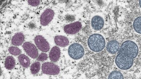 Monkeypox cases near 200 across DC, Maryland and Virginia