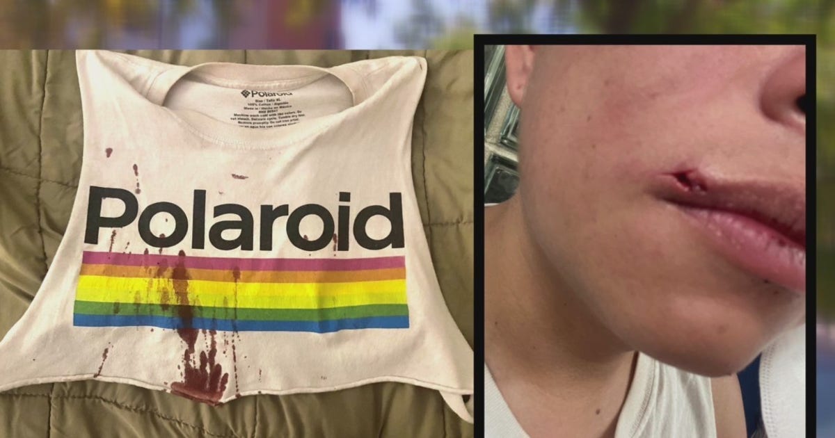 Gay couple attacked, accused of having monkeypox in Northwest DC | FOX 5 DC
