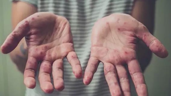 Montgomery County leaders push Maryland Gov. Hogan to provide more monkeypox vaccinations