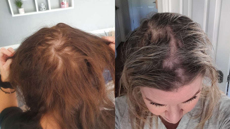 Plaintiff hair loss