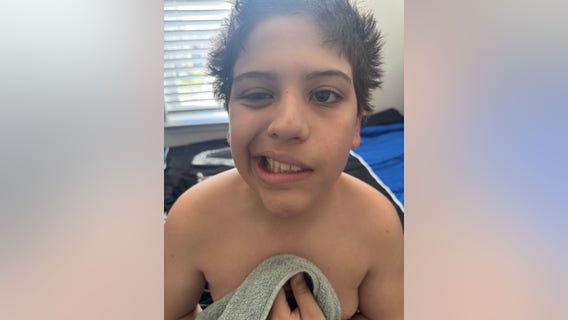 Virginia mom says son's face is partially paralyzed after being attacked by school bully
