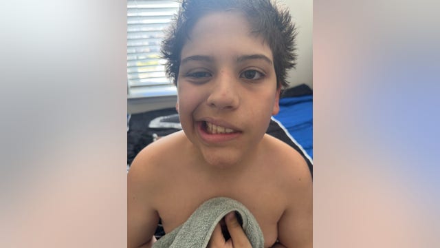 Virginia mom says son's face is partially paralyzed after being attacked by school bully