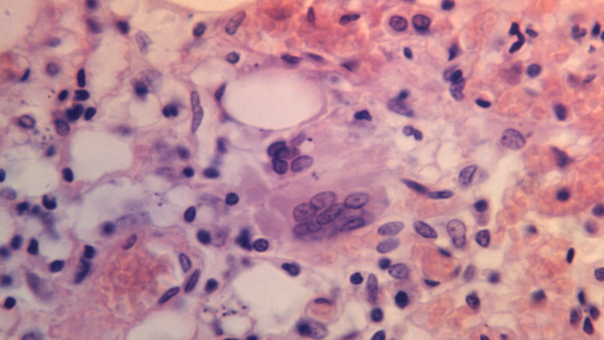 Measles warning issued across DMV region following confirmed case