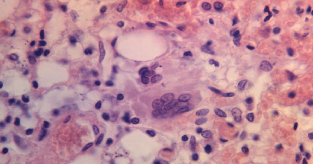 Measles warning issued across DMV region following confirmed case