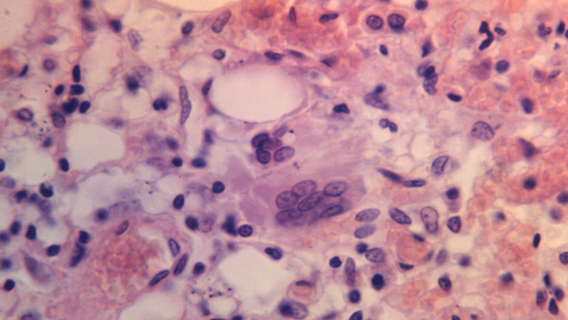 Measles warning issued across DMV region following confirmed case