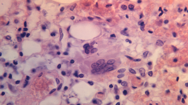 Measles warning issued across DMV region following confirmed case