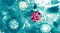 Cyclosporiasis in Maryland: MedStar Health reports latest case as summer infections rise