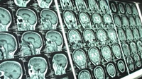 Study reveals alarming CTE rates in NFL players, highlighting risk of repetitive hits