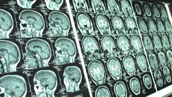 Study reveals alarming CTE rates in NFL players, highlighting risk of repetitive hits