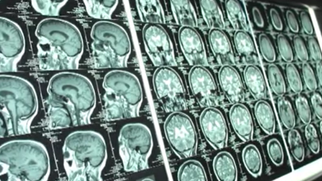 Study reveals alarming CTE rates in NFL players, highlighting risk of repetitive hits