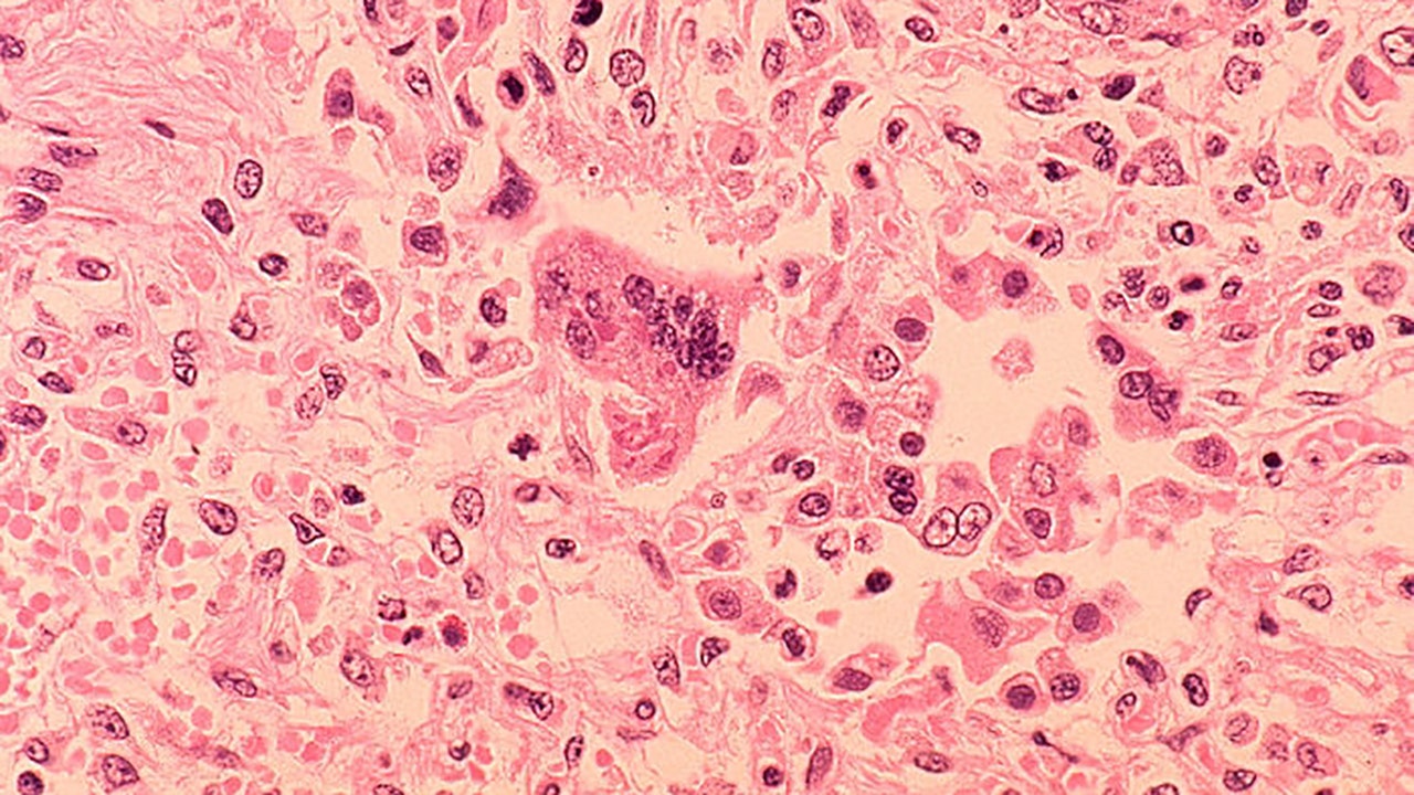 NJ health officials warn of possible measles exposure at Newark airport