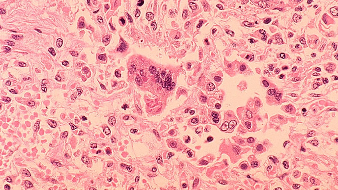 NJ health officials warn of possible measles exposure at Newark airport
