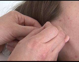 P MED TEAM ACCUPUNCTURE & MIGRAINES 5P_00.01.45.01_1490156749636-404959.png