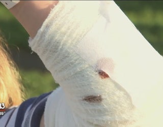 WTVT_citrusgatorattackvictim_082318 2-401385