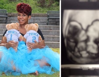 conjoined twins_1446666078788-404959.jpg