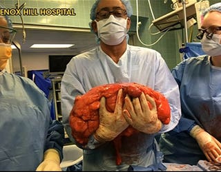 tumor1_1522323288995.jpg