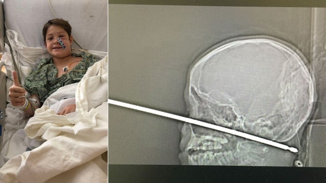 Boy, 10, survives being impaled in the face by a metal meat skewer