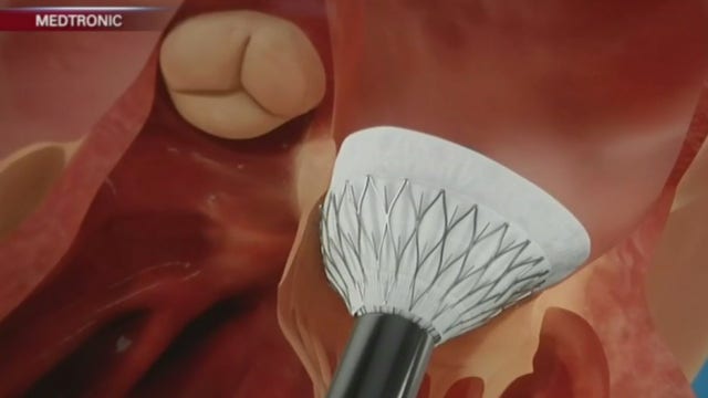 90-year-old man gets new heart valve derived from cow tissue