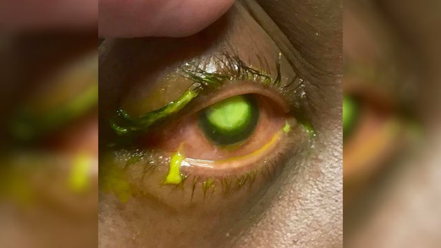 Eye doctor shares graphic photos as warning against sleeping in contact lenses