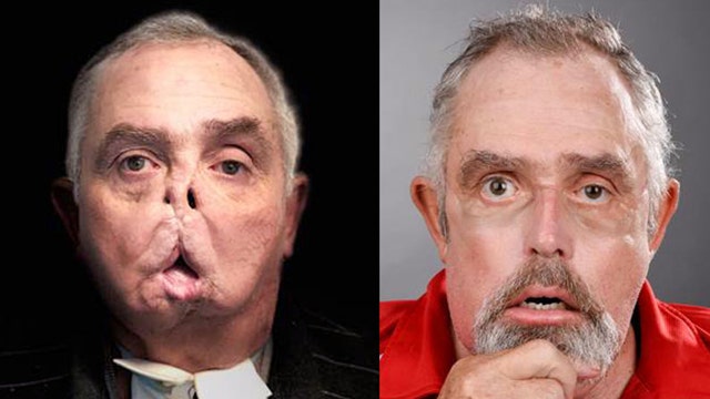 After horrific accident, face transplant restores man's ability to breathe, eat, speak