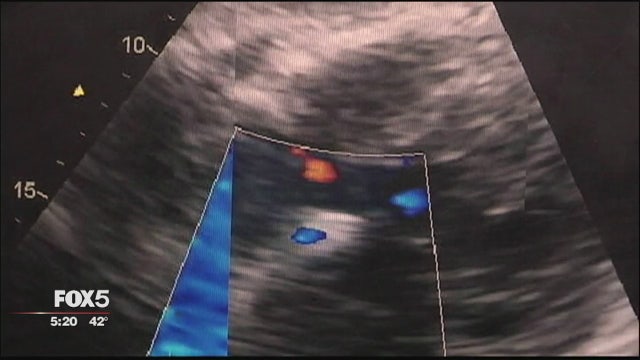 Doctors: Heart disease can be 'quiet killer' in women